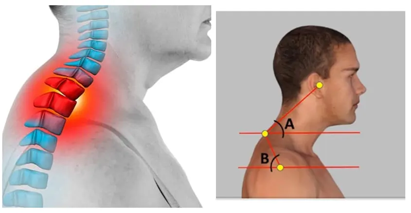 Foto de joven con protuberancia en la base del cuello