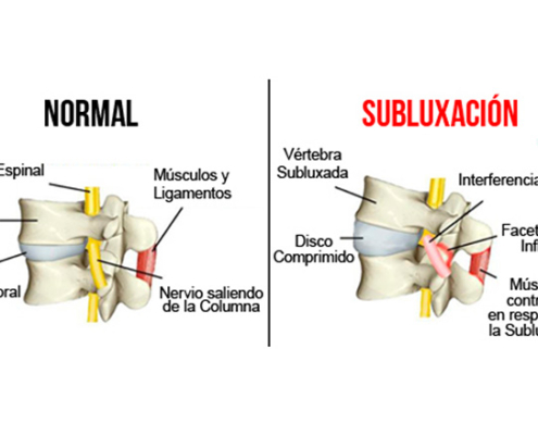 Imagen subluxación Quiropráctico Barcelona