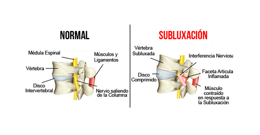 Imagen subluxación Quiropráctico Barcelona